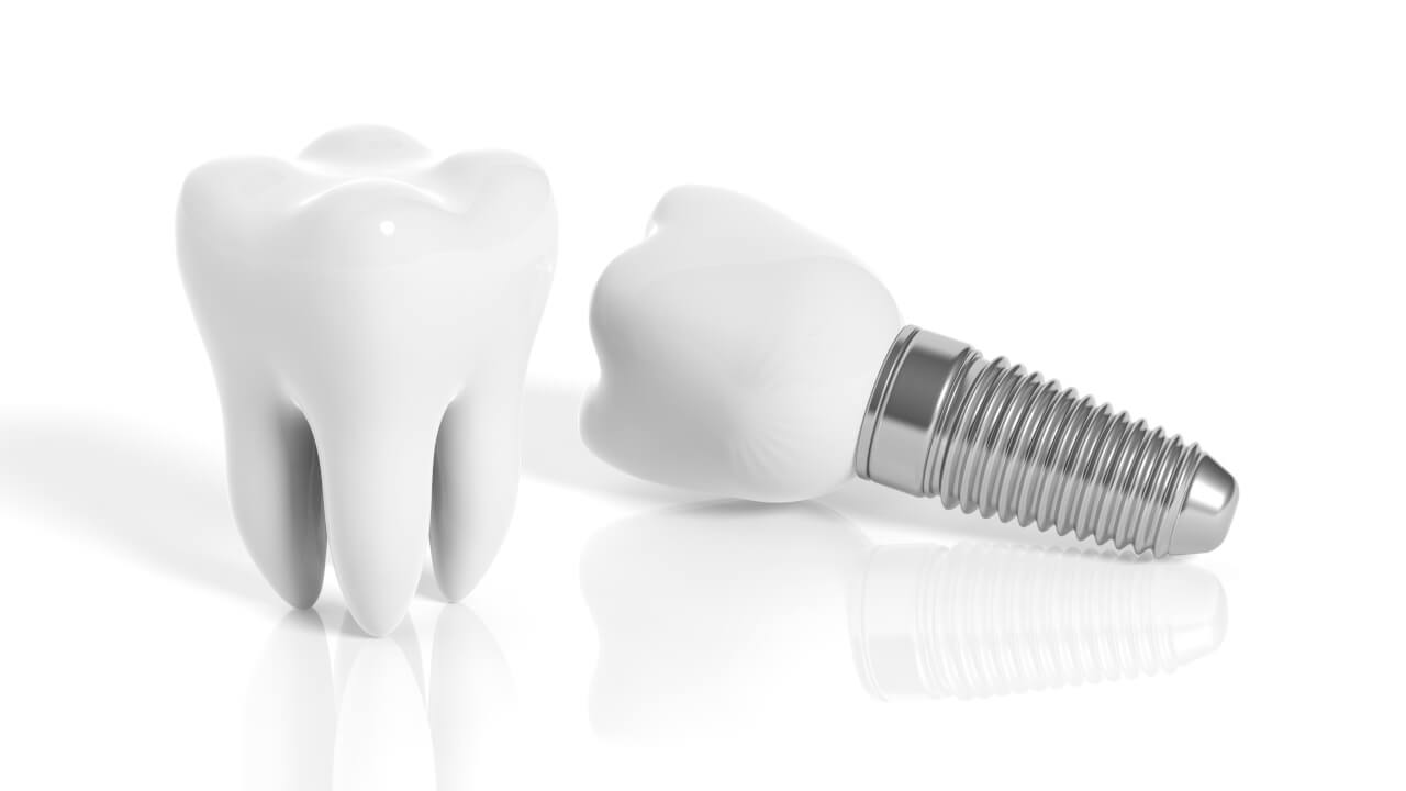 pros and cons of dental implants