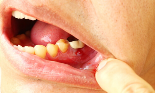 Broken Molar Tooth Causes And Treatment Options